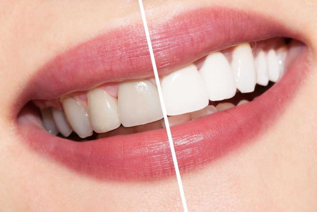 teeth-whitening-1024x687